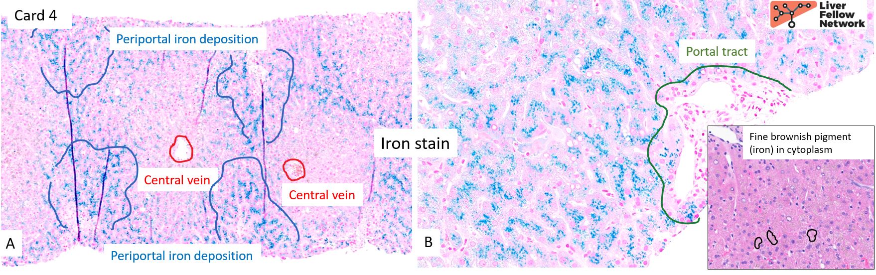 Liver Pathology | AASLD